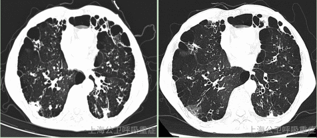 兩肺氣腫伴肺大泡;1.