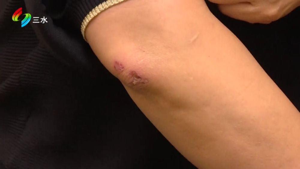 李女士,由于狗只体型巨大,先后两次将李女士扑倒在地,导致她手肘擦伤