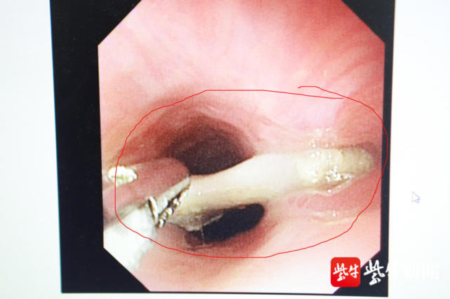家長趕緊將其送醫,在當地醫院做了胸部ct檢查,發現食道上段有一個異物