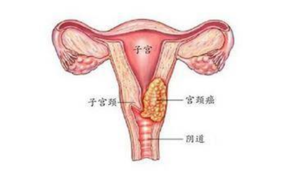 宫颈癌手术摘除子宫后女性身体会出现哪些变化癌症会就此消失吗