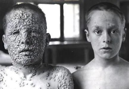 美实验室惊现天花毒株,万一泄露能杀死1/3地球人_腾讯新闻