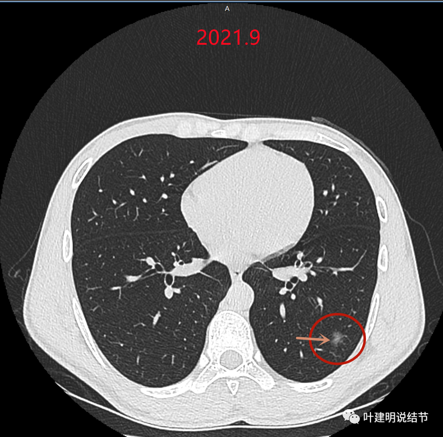 問診分析20211119同為肺磨玻璃結節一讓儘快手術一讓隨訪不急玄機在哪