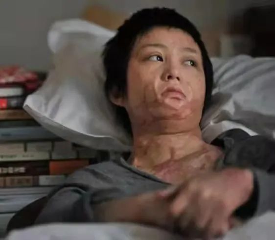 10年前那个被追求者纵火烧伤的女孩到现在依然是个受害者