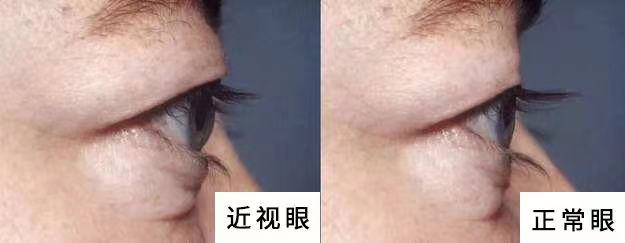 近视与高度近视的区别是什么?