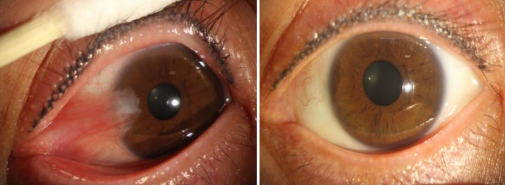 六旬老人眼睛里长出小翅膀原来是翼状胬肉在作怪