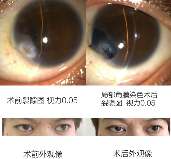 兰州爱尔科普：你听说过角膜染色吗？(图1)