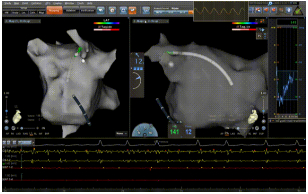 精彩病例丨cdqi名家面对面第五十五期:marshall静脉酒精消融在持续