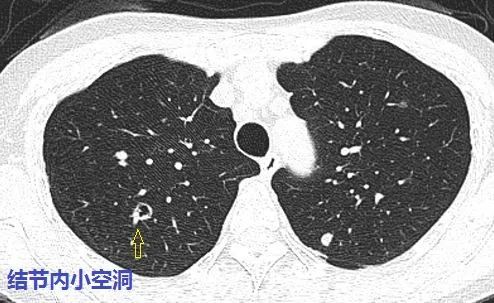 這個與血管相連的雙肺多發小結節是怎樣的神奇疾病