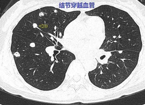 这个与血管相连的双肺多发小结节,是怎样的"神奇"疾病?