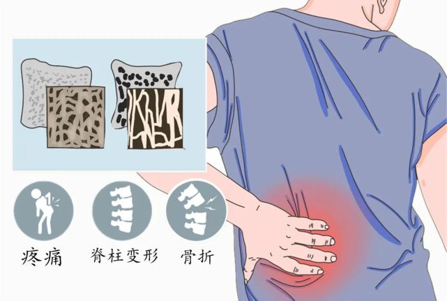 骨质疏松不可小觑,你以为真的就补钙那么简单吗?