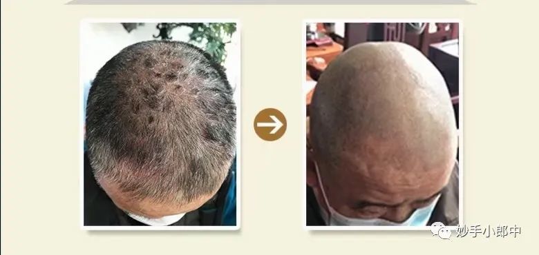 其实,祖国传统医学中医中药在治疗头癣方面有着很好的效果,妙手小郎中