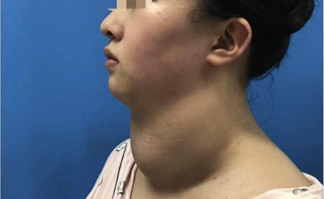 1,甲状腺激素的作用导致眼外肌增生.