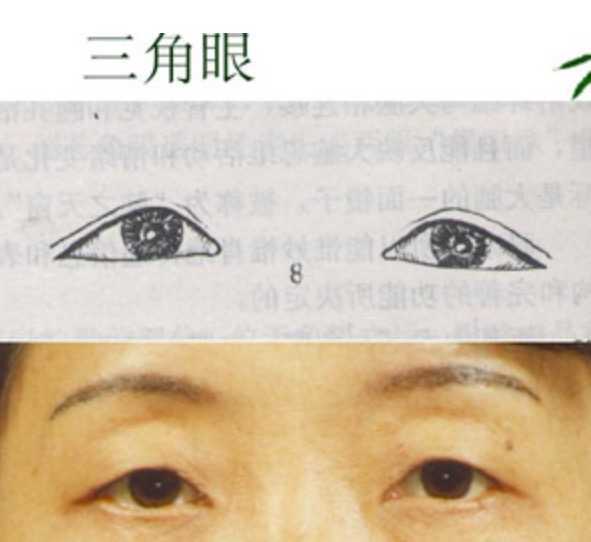 提眉之后出现了高低眉,三角眼怎么办?插图1