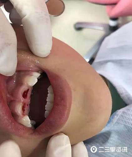 蒲城一小学生在校期间前门牙被磕掉学校已经在协调处理