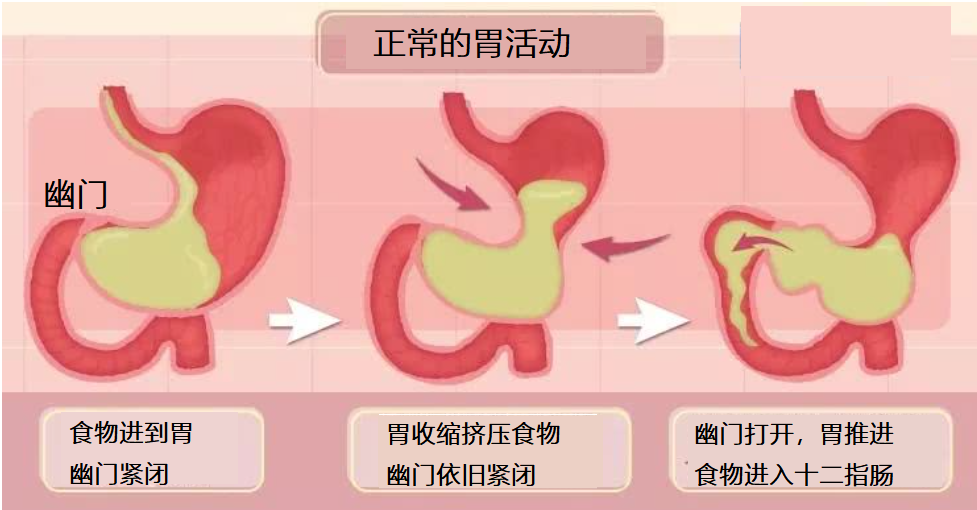 胃潴留图片消化不良图片