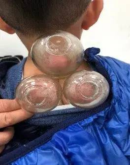 颛桥中医儿科主要采用中草药内服和小儿推拿,穴位贴敷,拔罐等中医传统