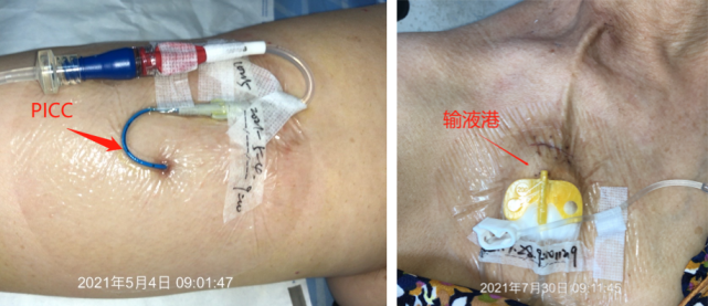 cvc并发血栓抗凝治疗要多久关于静脉导管相关血栓的9问9答