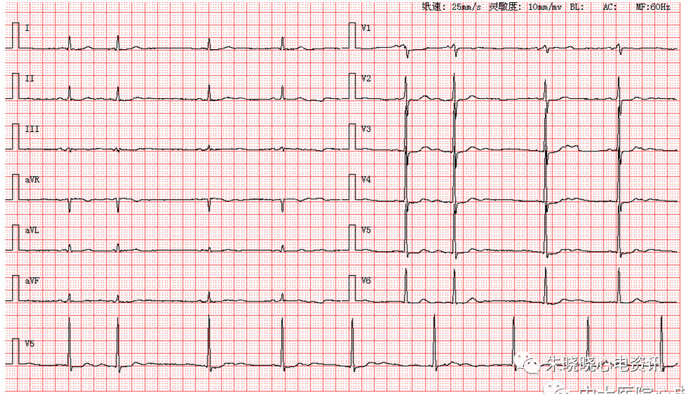 每日读图第1567期三度房室传导阻滞交界性逸博心律