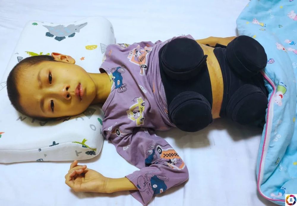 三年经历四次手术7岁男孩腹部伤痕累累单亲妈妈苦盼奇迹发生