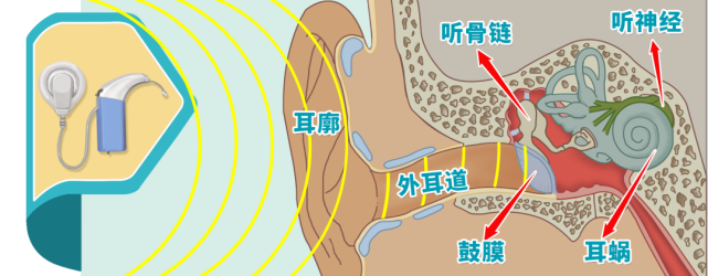 耳廓收集外界声音后,通过外耳道传入,使鼓膜,听骨链产生振动,再通过