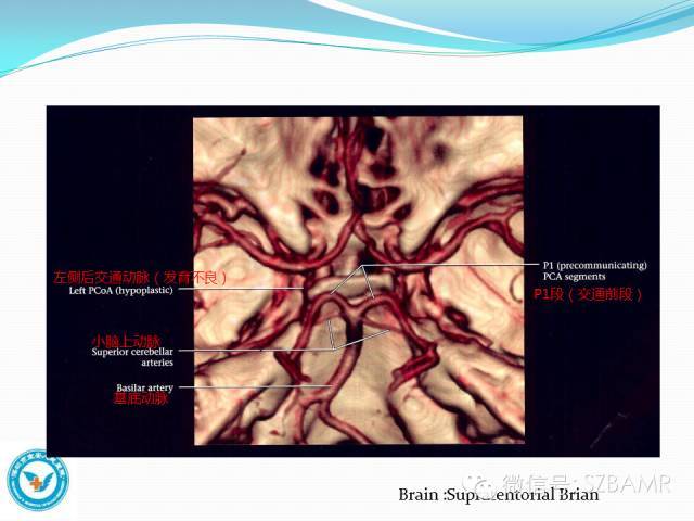 椎基底動脈系統cta,mra及dsa解剖