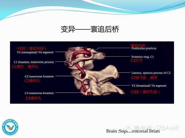 椎基底动脉系统ctmr及dsa影像解剖