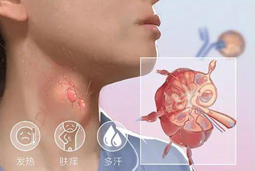 有哪些特点,是否可以治愈呢|淋巴肿大|淋巴瘤|霍奇金淋巴瘤|肿瘤|病症
