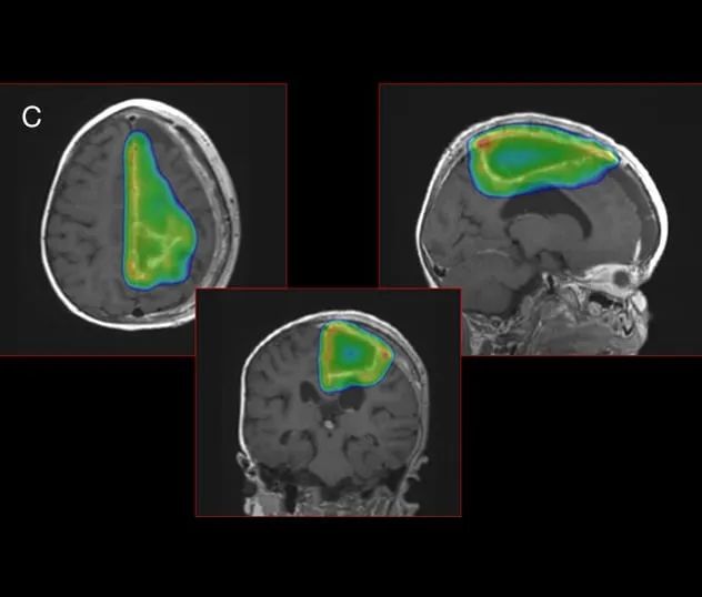 腦膜瘤男孩質子治療後腫瘤減少903年無復發