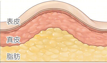 人体有两种脂肪,一种是皮下脂肪,比如抓起皮肤后那一叠叠的肉,拜拜肉