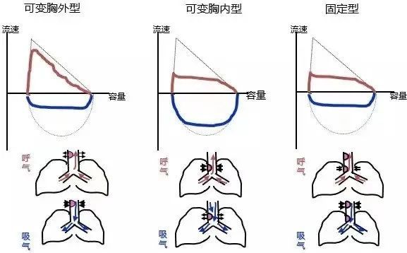 肺功能除了雙蝶形大氣道阻塞還有這4種曲線特徵