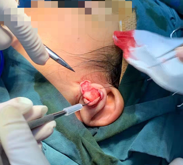 我打耳洞是为了美没想到长出个大瘤子杭州一女士为此挨刀手术