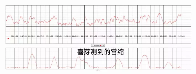 宫缩,会不会导致胎儿缺氧?