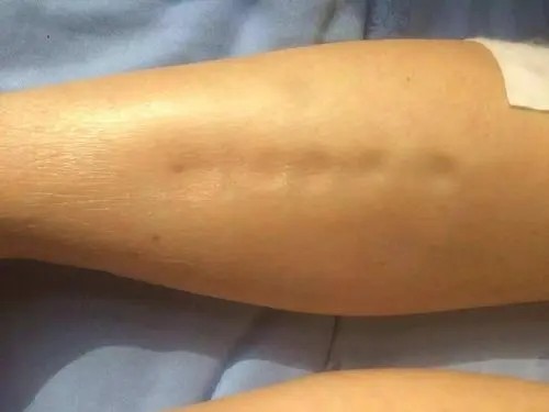 我听说腿肿脚肿是得肾病啦!你还拖着干啥?拖到尿毒症就麻烦啦!