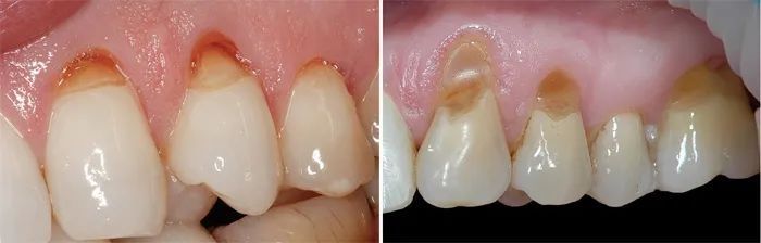 牙上出现这种小凹槽!小心断牙!_腾讯新闻