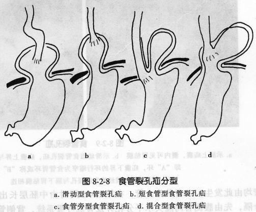 小(侷限性黏膜皺襞紊亂和中斷,侷限性管壁僵直;小充盈缺損,小龕影)