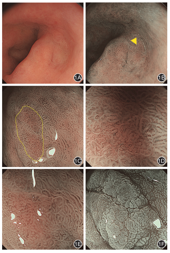 202109病例胃窦超高分化腺癌伴同时性微小高分化腺癌一例