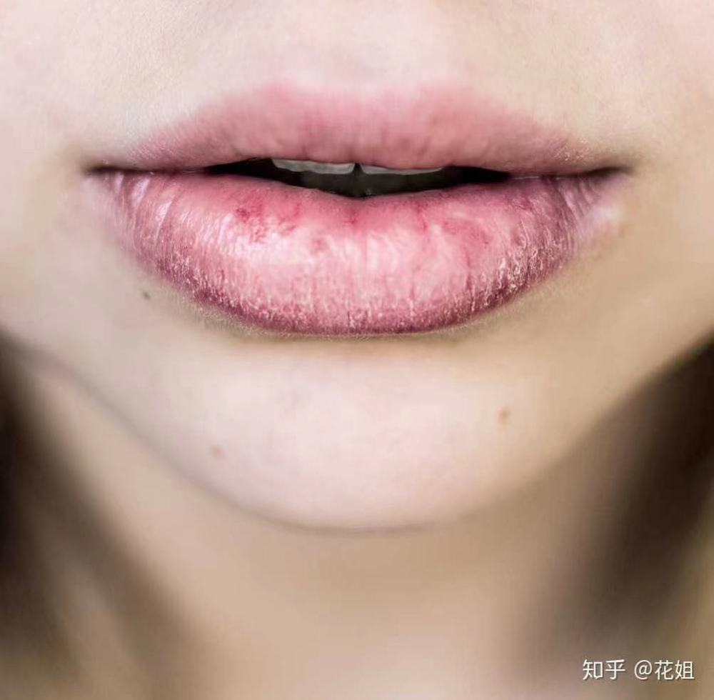 冬天嘴唇干裂 常用这三招 让你嘴唇更滋润 腾讯新闻