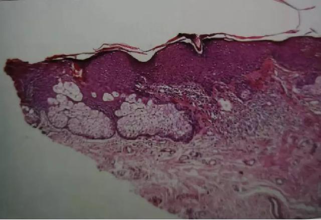 瘰疬分枝杆菌感染,无传染性,普遍存在于美国东南部地区