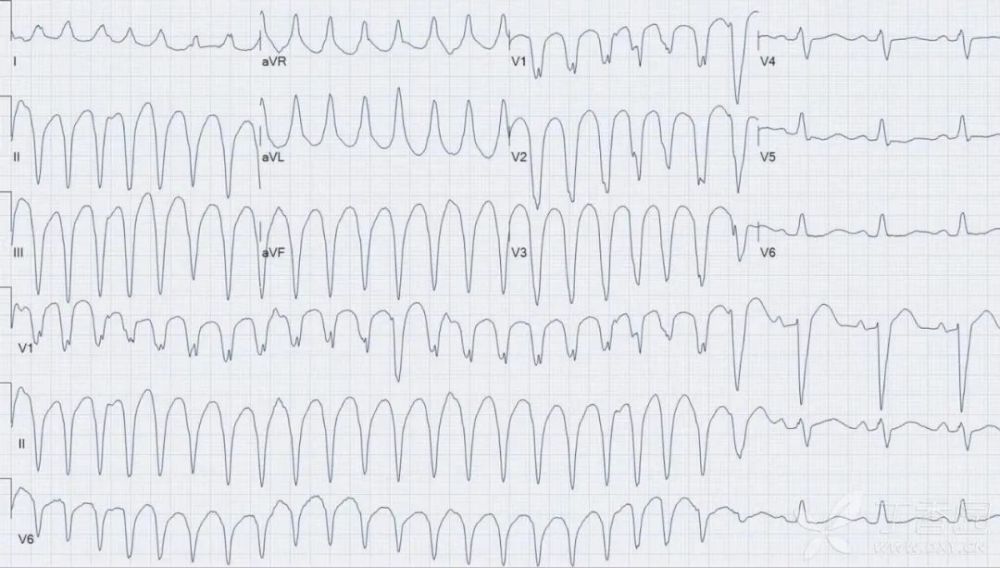 今日识图室速or室上速