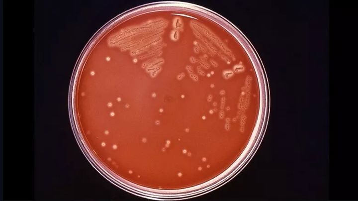 噬肉菌症图片