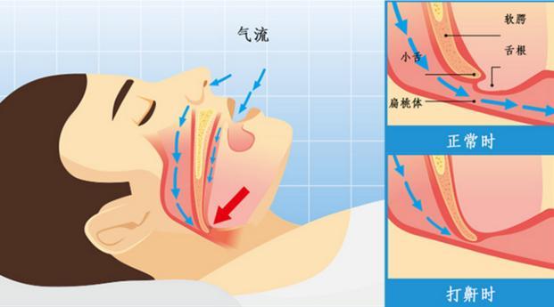 而躺下的時候,這個放鬆的小舌頭就會下垂,離我們的氣道很近.