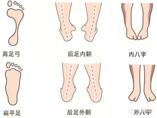 新體態踮腳o型腿扁平足外八字幼兒異常走路姿勢的原因和改善方式