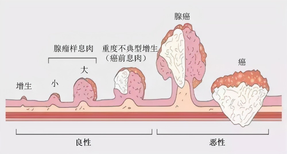 平时好好的,突然就检出肠癌晚期?带你揭开肠息肉癌变的面纱!