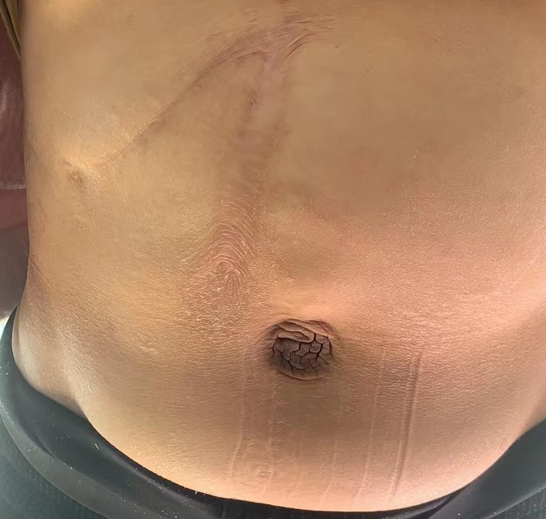 刘教授团队钟伟主任患者肝硬化大量顽固性腹水,脐疝形成中药化解