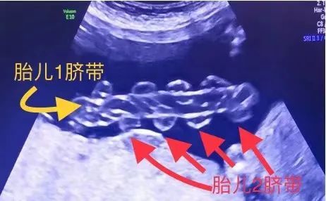 双胞胎脐带缠成中国结医生惊出了一身冷汗