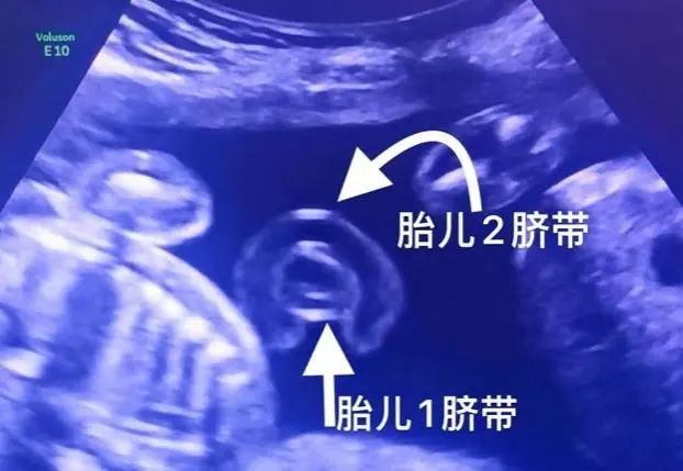 双胞胎脐带缠成中国结医生惊出了一身冷汗