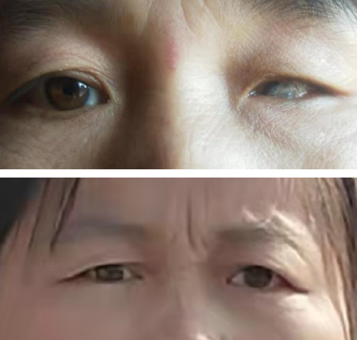 女子失明40载导致眼球萎缩,义眼台植入术后重获自信人生