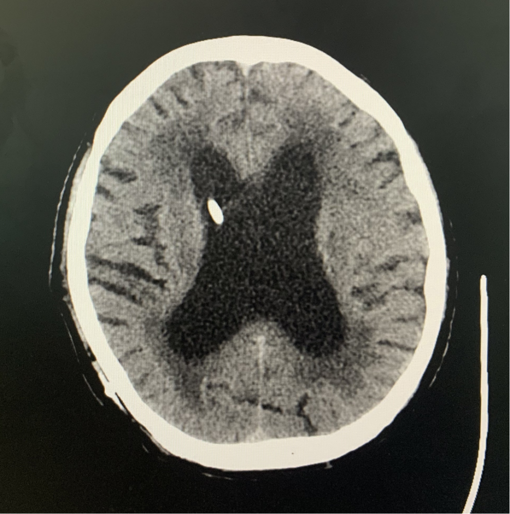 神外例说|天津市环湖医院郭芳:特发性正常压力脑积水(inph)行走障碍的