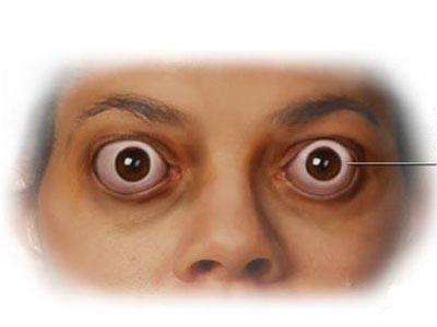 严重的突眼会造成眼睑闭合不全,长此以往还会导致暴露性角膜炎,角膜