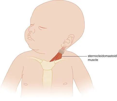 婴儿斜颈症状图片